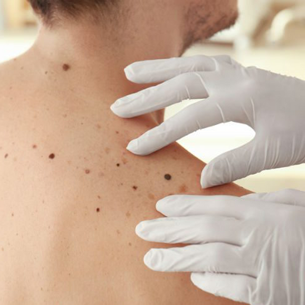 Skin Cancer: Have You Been Checked?